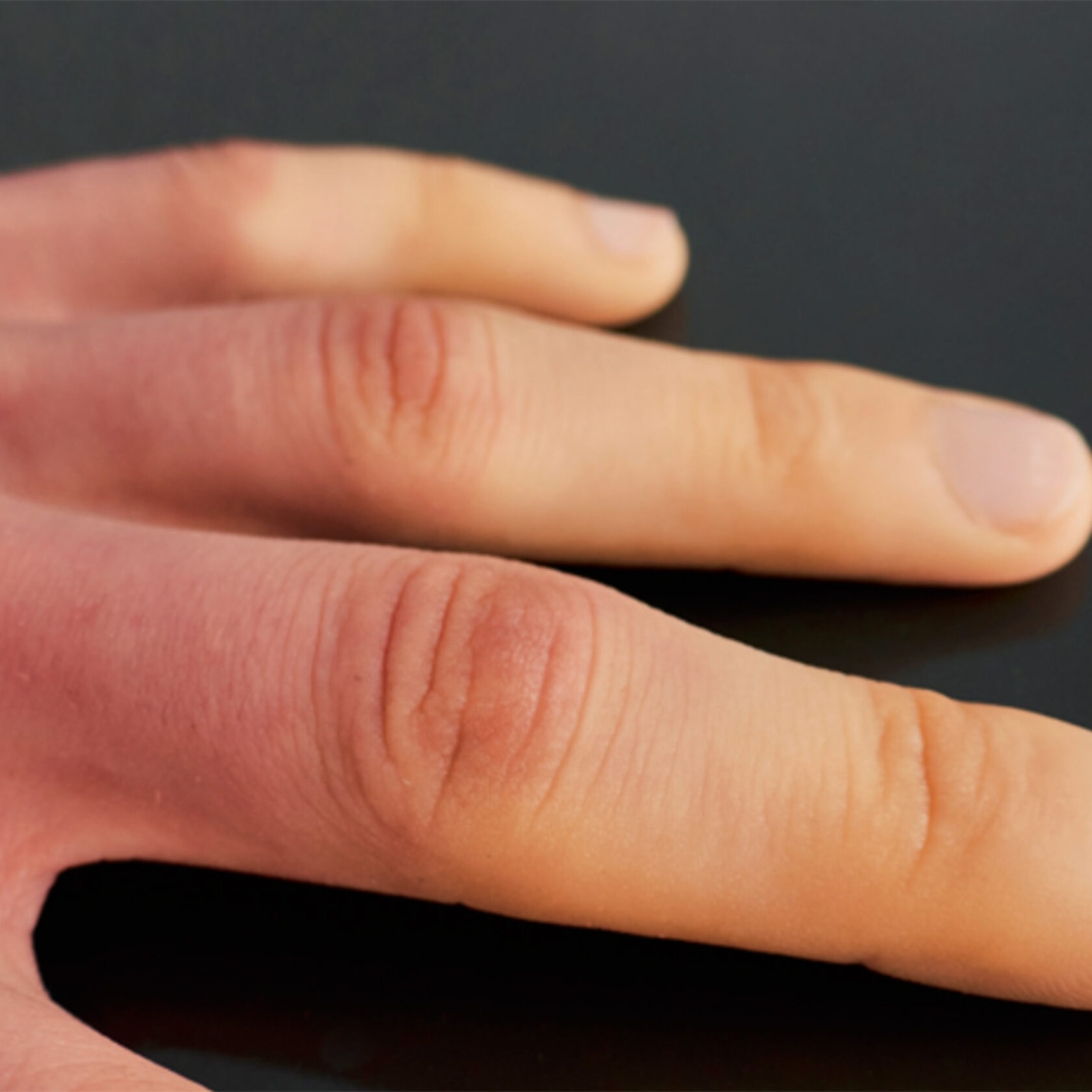 Hand zeigt Effekte auf Raynaud-Symptome