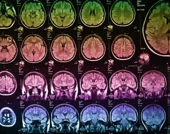 Gehirn-Scans (MRT)
