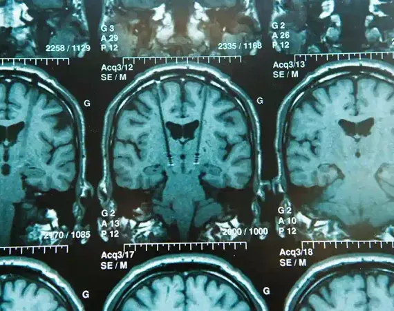 Substantia nigra im Gehirn-Scan