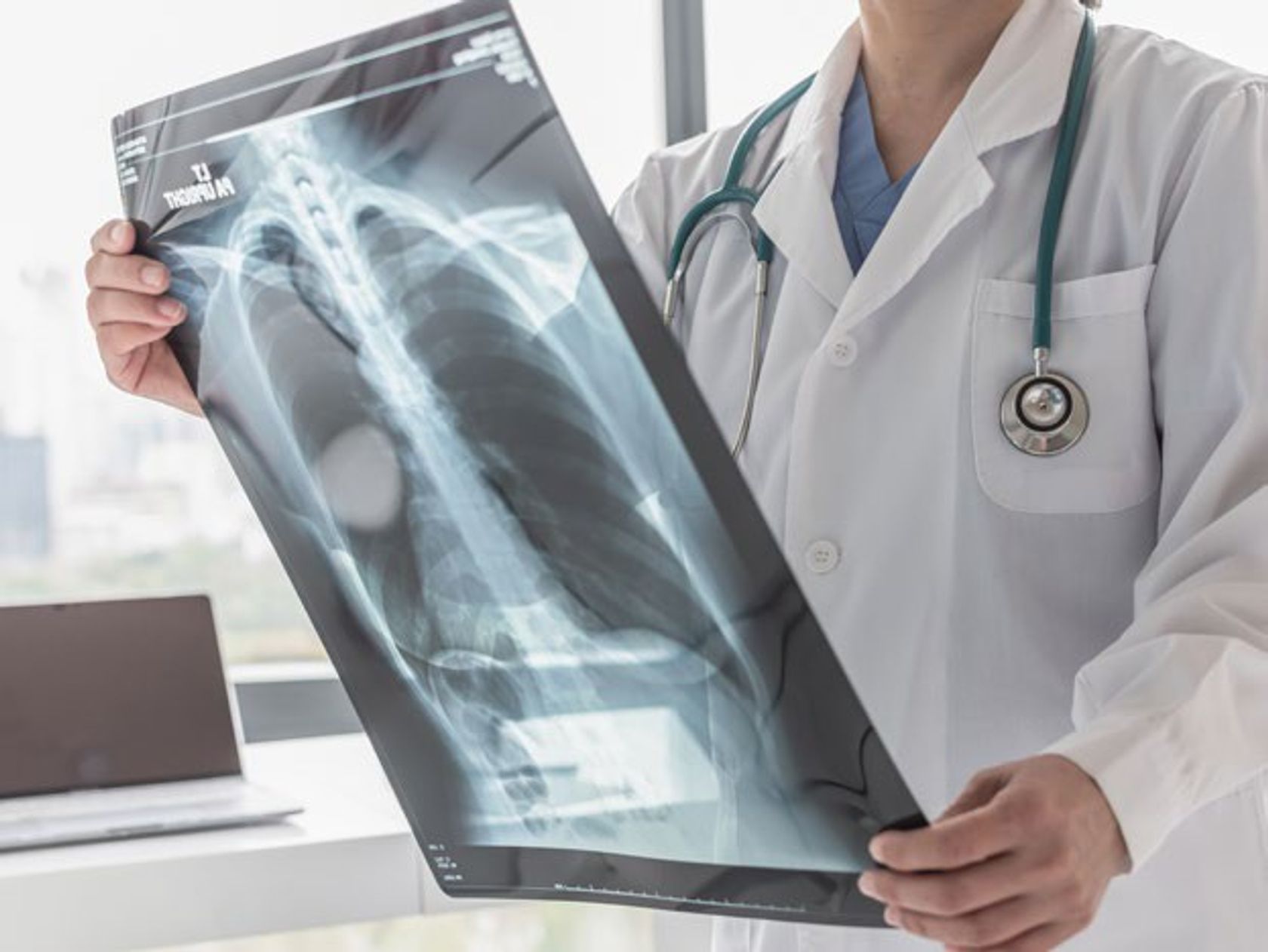 Arzt hält Röntgenaufnahme einer Lunge in den Händen und betrachtet sie.