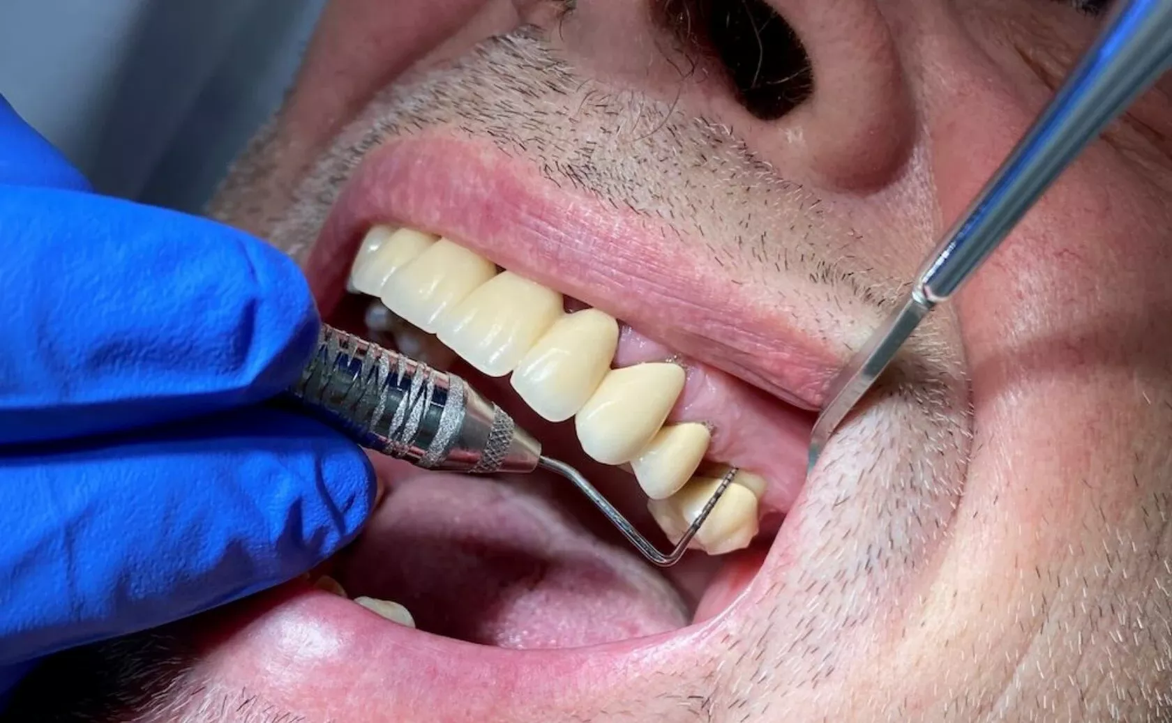 Behandlung der Parodontitis beim Mann in der Zahnarztpraxis.