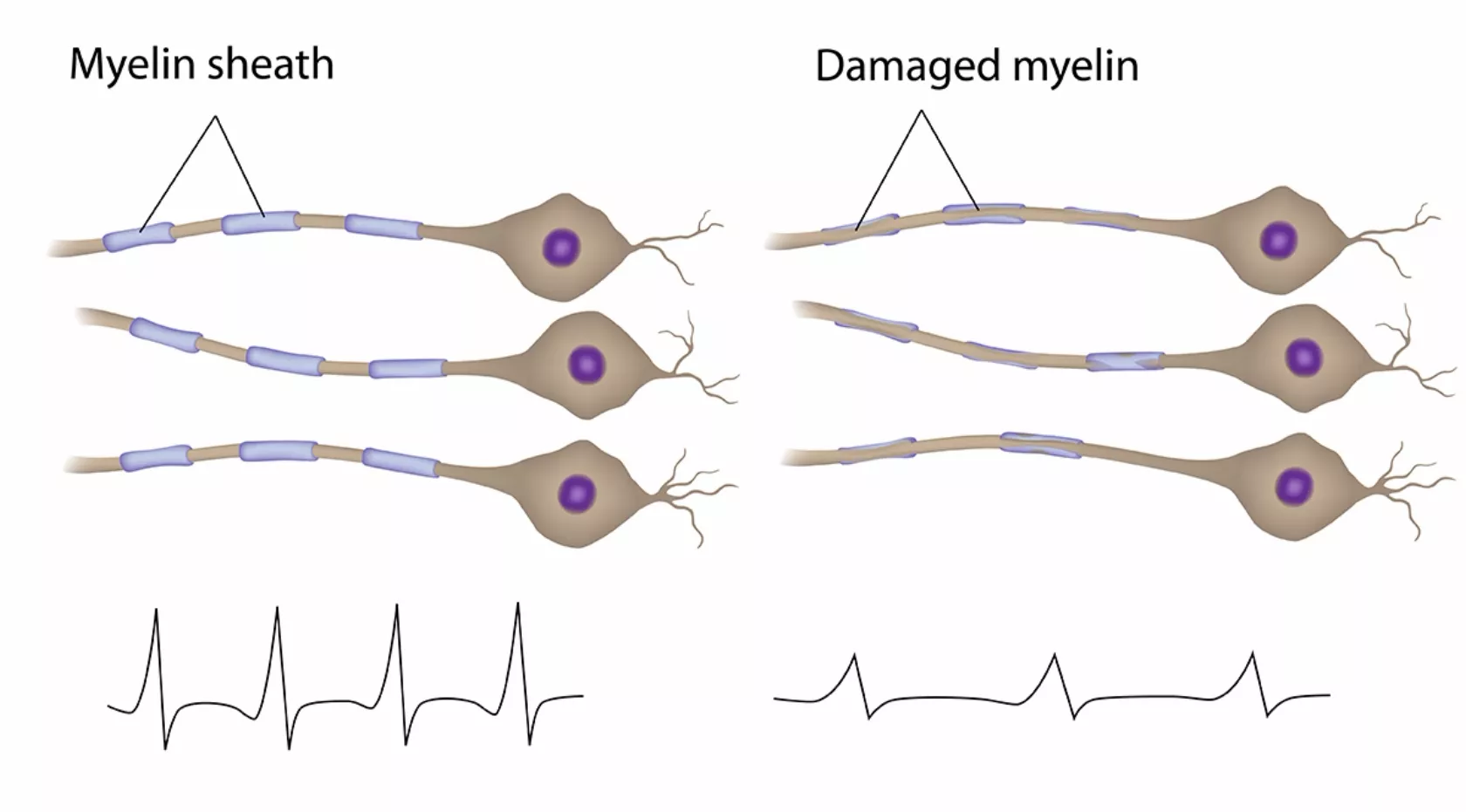 Darstellung von gesunden und demyelinisierten Nervenzellen.