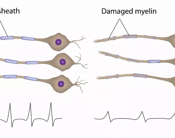 Darstellung von gesunden und demyelinisierten Nervenzellen.